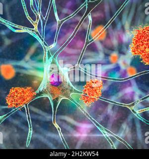 Cellule nervose colpite dal morbo di Alzheimer, illustrazione Foto Stock