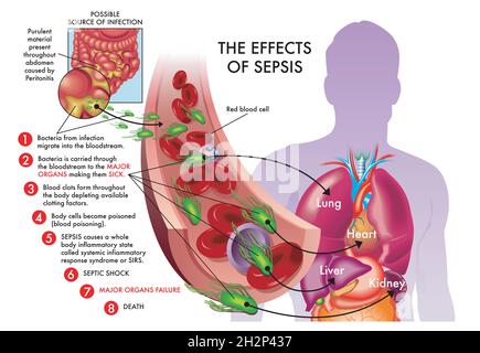 Illustrazione medica degli effetti della sepsi. Foto Stock