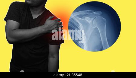 Primo piano spalla e clavicola frattura dolore in un uomo, giovane uomo che tiene la sua spalla in dolore infiammazione della spalla sintomi medico concep Foto Stock