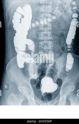 Esame radiologico per cercare le anomalie del colon da enema la polvere di bario e l'aria nell'ano. Quindi è stata eseguita la radiografia. Concetto di immagine medica. Foto Stock