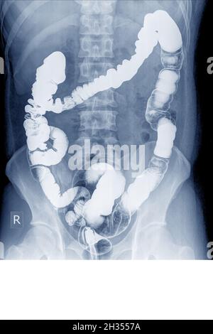 Esame radiologico per cercare le anomalie del colon da enema la polvere di bario e l'aria nell'ano. Quindi è stata eseguita la radiografia. Concetto di immagine medica. Foto Stock