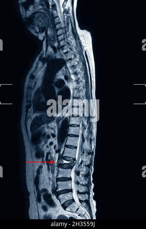 MRI LS-rachide che mostra una frattura di burst del corpo vertebrale L2 con grave collasso vertebrale,concetto di immagine medica. Foto Stock