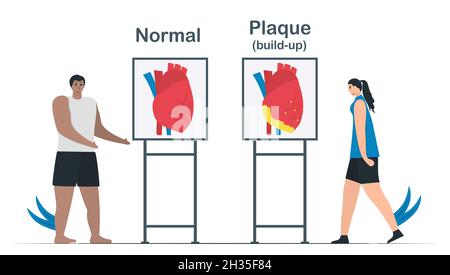 Confronto tra cardiopatia normale e coronaropatia. L'accumulo di placche può crearsi di depositi di colesterolo nell'arteria. Illustrazione del vettore di cardiologia Illustrazione Vettoriale