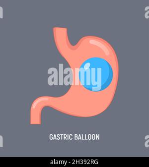 Palloncino gastrico perdita di peso chirurgia intragastrica. Icona del  vettore di funzionamento del palloncino gastrico dello stomaco Immagine e  Vettoriale - Alamy