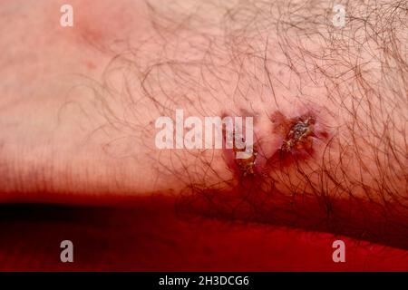 Una grande cicatrice in una gamba di un uomo Foto Stock