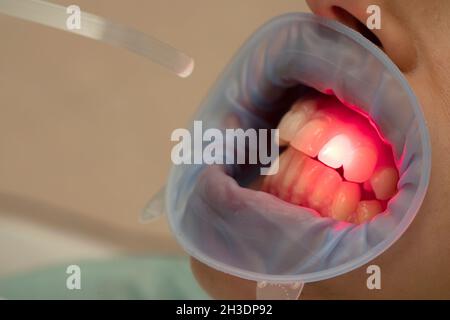 Terapia dentale con luce LED rossa in studio dentale Foto Stock