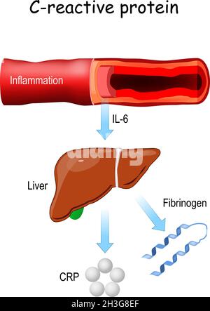 Proteina C-reattiva, e citochina pro-infiammatoria il-6. Infiammazione dei vasi sanguigni. Rilascio epatico di fibrinogeno e CRP. Illustrazione Vettoriale