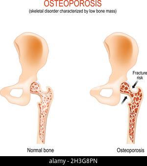 Osteoporosi. Articolazione e osso normali dell'anca con disturbi scheletrici caratterizzati da una bassa massa ossea. Rischio di frattura del femore. Differenza e confronto Illustrazione Vettoriale