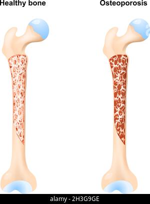 Osso sano, e Osteoporosi. Sezione trasversale del femore umano. Illustrazione vettoriale Illustrazione Vettoriale