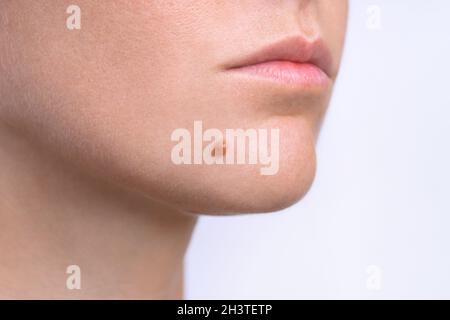 Mole sulla faccia. Faccia della giovane donna con marchio di nascita o nevo. Spazio di copia Foto Stock