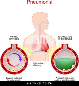 Polmonite. Infezione polmonare. Infiammatorio del sistema respiratorio. Primo piano di alveoli e alveoli sani con liquidi Illustrazione Vettoriale