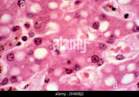 Plasmodium falciparum malaria: Fegato Foto Stock