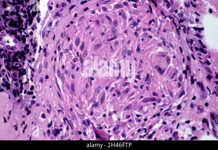 Leishmaniosi cutanea: Lesione cutanea Foto Stock