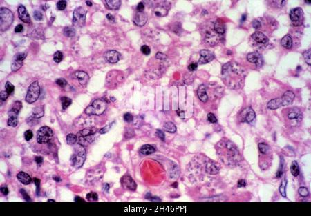 Leishmaniosi cutanea: Lesione cutanea Foto Stock