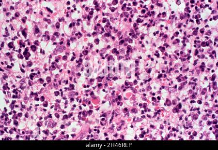 Leishmaniosi cutanea: Lesione cutanea Foto Stock
