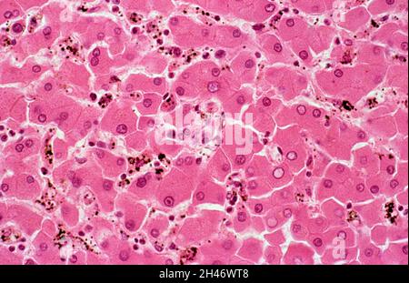 Plasmodium falciparum malaria: Fegato Foto Stock