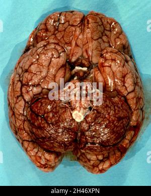 Malaria da Plasmodium falciparum: Malaria cerebrale Foto Stock