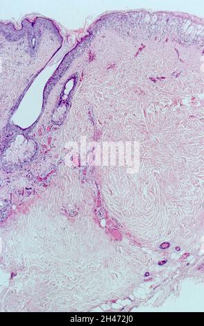 Pelle: Vasculite di Pseudomonas aeruginosa Foto Stock