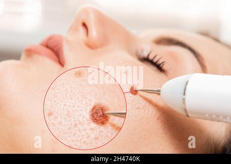 Elettrocoagulazione e cosmelotogia laser. Dermatologo che utilizza un elettrocauterizzazione professionale per la rimozione del talco. Area ingrandita del melanoma. Foto Stock