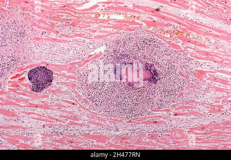 Infezione da Staphylococcus aureus: Ascesso cardiaco Foto Stock