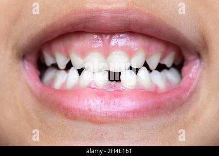 Bambina (7 anni) anteriore mancanti due denti e azienda apple Foto stock -  Alamy