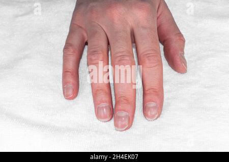 Mano femmina caucasica con unghie naturali rotte non lucidate, cuticole sopraffatte su sfondo bianco tessile, vista dall'alto. Cura delle unghie. Unghie bellezza e hea Foto Stock