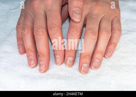 Le mani femminili caucasiche con unghie naturali rotte non lucidate, cuticole sopravelte su sfondo bianco tessile, vista dall'alto. Il concetto di unghie naturali, Foto Stock