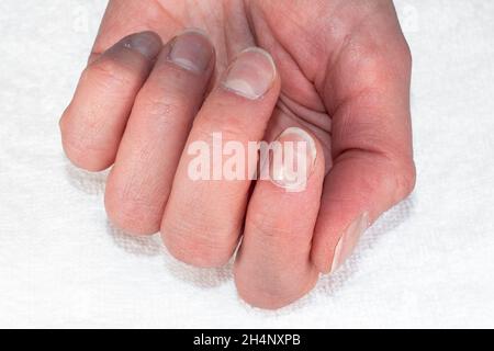 Primo piano di una mano femmina caucasica con unghie naturali non lucidate, cuticole sopravolte su sfondo bianco tessile, vista dall'alto. Bellezza e salute delle unghie Foto Stock