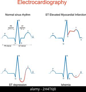Elettrocardiografia. ECG o EKG di un cuore con ritmo sinusale normale, infarto miocardico ST elevato, isemia, sottoslivellamento ST, differenza e compari Illustrazione Vettoriale