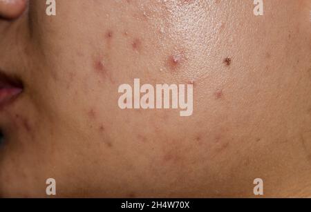 Acne , macchie nere e cicatrici sulla faccia della giovane donna asiatica. Foto Stock