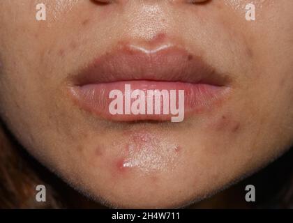 Acne, macchie nere e cicatrici sulla faccia della giovane donna asiatica. Foto Stock