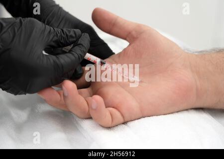 il medico fa un colpo di tossina botulinica nelle mani di un palmo maschio contro sudorazione eccessiva, trattamento di iperidrosi Foto Stock