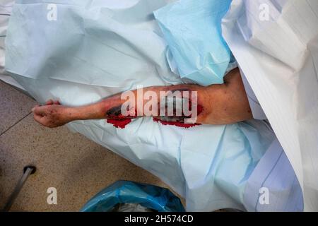 il braccio di un paziente presenta gravi lesioni cutanee Foto Stock