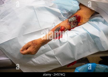 il braccio di un paziente presenta gravi lesioni cutanee Foto Stock