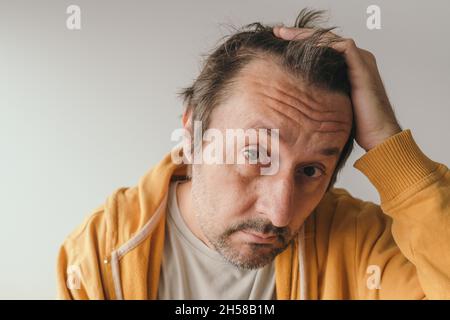 Perdita dei capelli, uomo che guarda lo specchio preoccupato di perdere i capelli alla fronte, fuoco selettivo Foto Stock