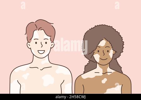 Vitiligo e concetto misto di amore di gara. Giovane donna sorridente e coppia uomo in piedi insieme avendo vitiligo su volti e corpi sensazione di amore vettore illustrazione Illustrazione Vettoriale