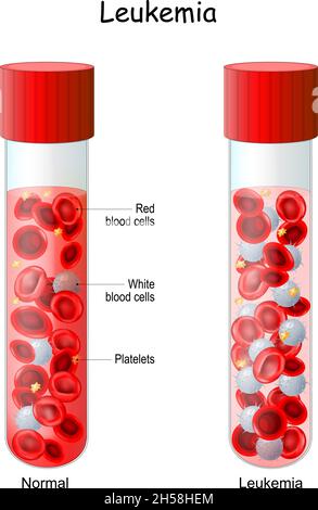 Leucemia. Provetta di confronto e differenza con sangue normale e tumore del sangue. Primo piano dei globuli rossi e dei linfociti. Illustrazione vettoriale Illustrazione Vettoriale