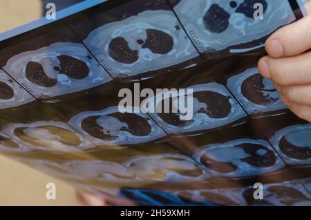 La scansione TC è in mano a un uomo. Vista trasversale o piana assiale del torace TC che mostra lo studio normale di cuore, polmoni, colonna vertebrale, costola, altro. Focus selettivo Foto Stock