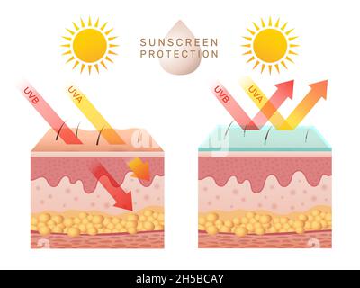 Protezione della pelle dai raggi UV. Bucce della pelle umana danneggiate prima e dopo la protezione solare corpo strati adiposi epidermide recente modello infografico vettoriale Illustrazione Vettoriale