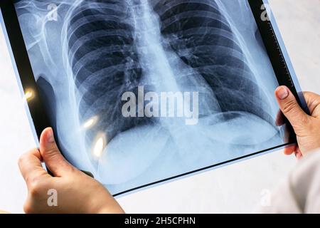 Mani donna con raggi x medici blu di scansione toracica su sfondo chiaro. Malattia di Covid, esame del cancro, polmonite, asma e diagnosi di tubercolosi Foto Stock