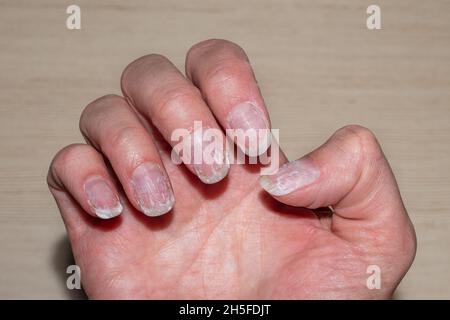 Primo piano di chiodi squali e fragili senza manicure. Dopo la lucidatura con gel, la cuticola delle unghie è ricampionata e la piastra delle unghie danneggiata. Problema di salute e bellezza Foto Stock