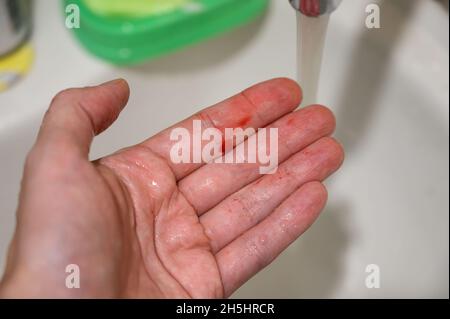 Sangue sulle dita numan. Sanguinamento dal naso. Foto Stock