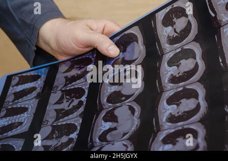 La mano di un uomo tiene una scansione tomografica del suo petto. Esame di un paziente nel reparto di radiologia di un ospedale. Covid-19 o polmonite. Se Foto Stock