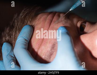 Medico cosmetologo fa anti-invecchiamento iniezioni nella fronte di un uomo contro le rughe. Primo piano Foto Stock