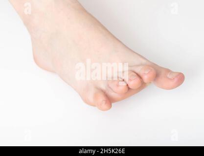 Le dita dei piedi storte della ragazza, primo piano. Difetto estetico, sindrome del piede storto, problema Foto Stock