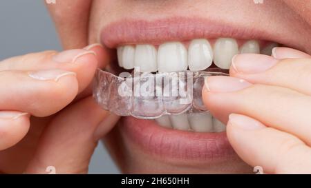 Donna caucasica che mette su aligners. Dispositivo raddrizzatore per denti ortodontici. Foto Stock