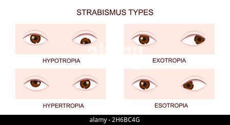 Tipi di strabismo. Ipotropia, ipertropia, esotropia, esotropia. Occhi umani con diversi disturbi dello squint. Condizione occhi incrociati. Illustrazione vettoriale realistica. Illustrazione Vettoriale