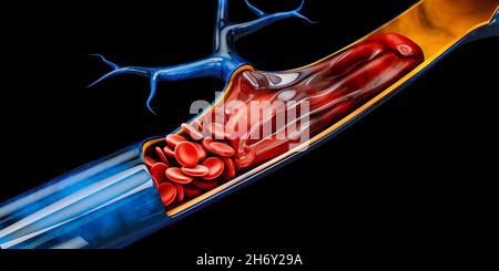 Illustrazione 3d della trombosi venosa profonda o dei coaguli di sangue. Embolia, tracciato di ritaglio incluso. Foto Stock