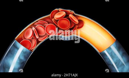 Illustrazione 3d della trombosi venosa profonda o dei coaguli di sangue. Embolia, tracciato di ritaglio incluso Foto Stock