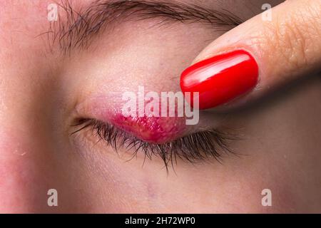 Chalazio arrossato sulla palpebra di un occhio femminile Foto Stock